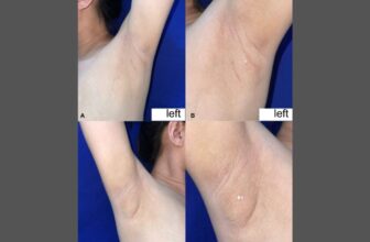 Girl With Uncommon Situation Has Armpits That Leak Milk